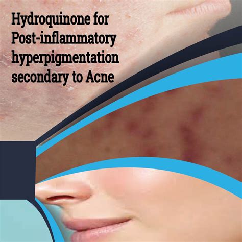 Hydroquinone Post Inflammatory Hyperpigmentation