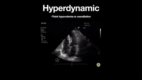 Hyperdynamic Left Ventricle