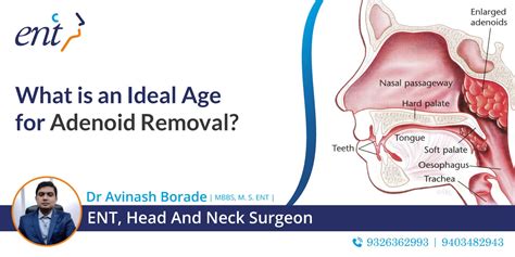 Ideal Age For Adenoid Removal