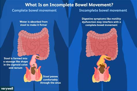 Incomplete Bowel Voiding