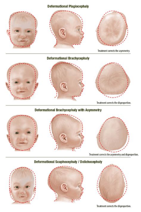 Infant Head Shape