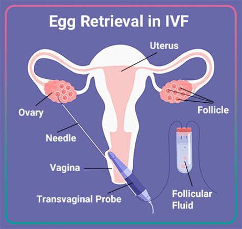 Ivf Egg Retrieval