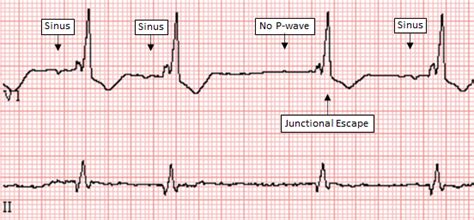 Junctional Escape Beat