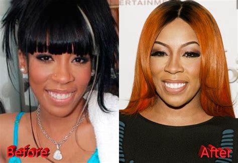 K Michelle Before And After Face Surgery