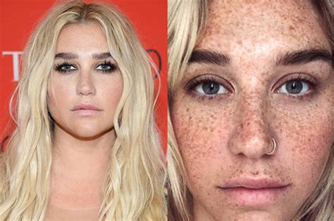 Kesha Face Surgery