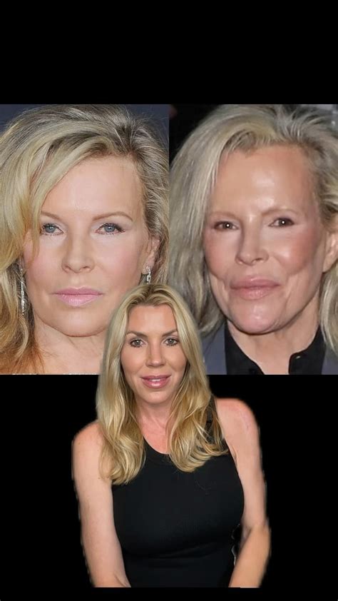 Kim Basinger Face Surgery