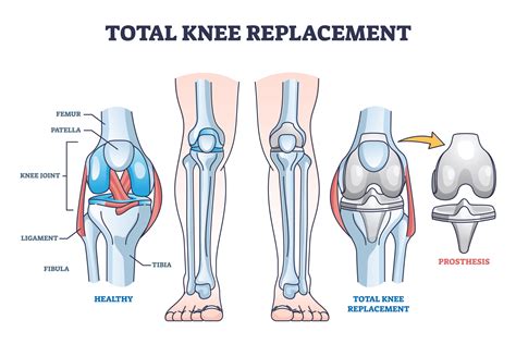 Knee Surgery Types