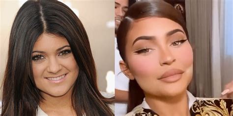 Kylie Jenner Before And After Face Surgery