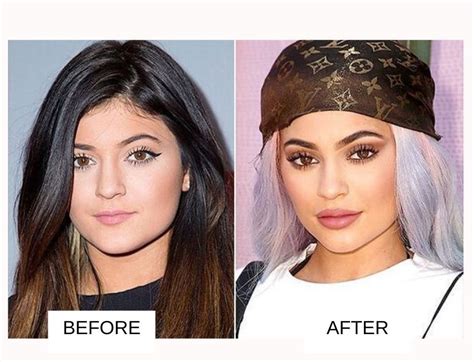 Kylie Jenner Plastic Surgery Face
