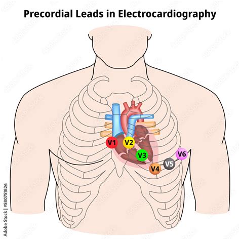Lead Precordial