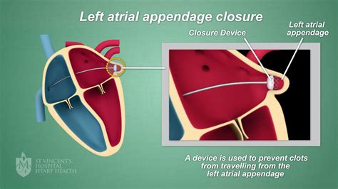 Left Atrial Appendage Occlusion