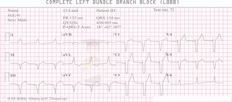 Left Bundle Branch Block Symptoms