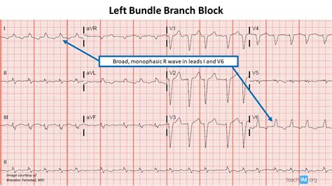 Left Bundle Branch