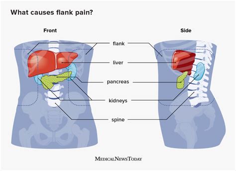 Left Flank Pain
