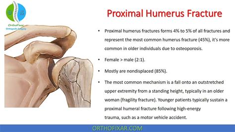 Left Humerus Fracture