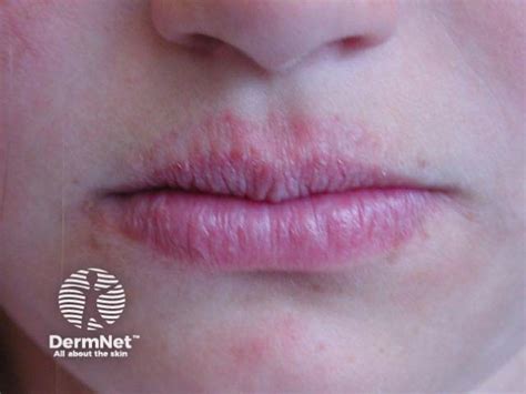 Lip Lickers Dermatitis