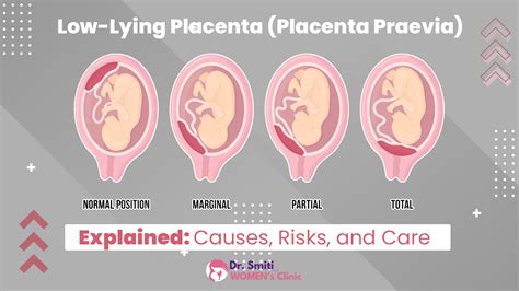 Low Lying Placenta