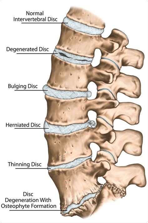Lumbar Degenerative Disk