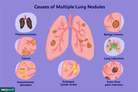 Lung Nodules Causes