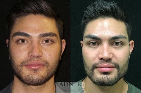 Male Plastic Surgery Face