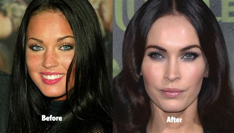 Megan Fox Face Plastic Surgery
