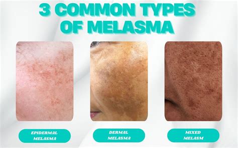 Melasma Or Pigmentation