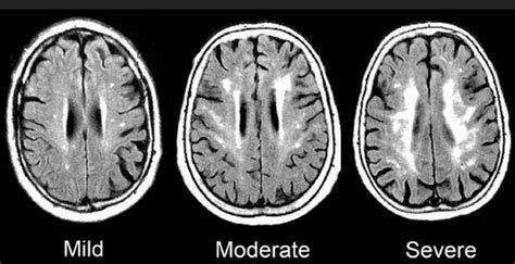 Mild Chronic Microvascular Ischemic Changes