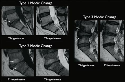 Modic Type 1 Endplate Changes