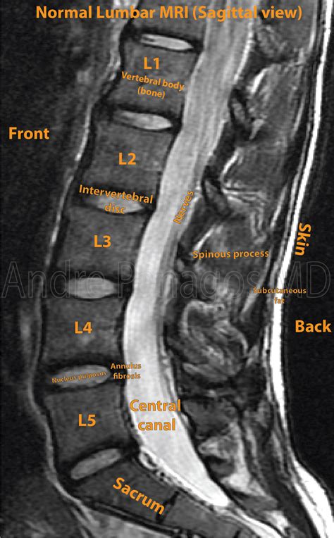 Normal Lumbar Mri