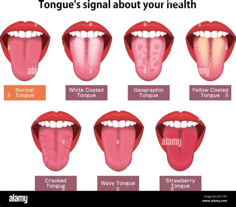 Normal Tongue Color