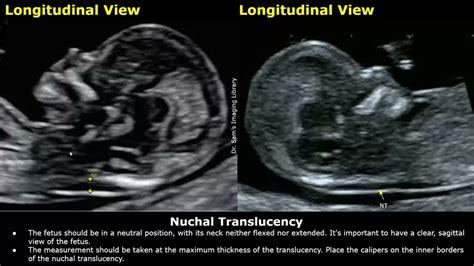 Nuchal Translucency Screening