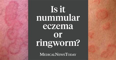 Nummular Eczema Vs Ringworm