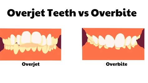 Overjet Vs Overbite