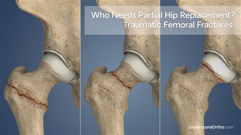 Partial Hip Replacement