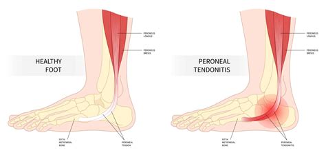 Peroneal Tendonitis Pain Location