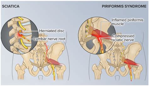 Piriformis Syndrome Vs Sciatica