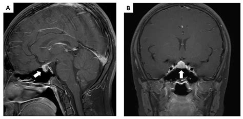 Pituitary Microadenoma Mri