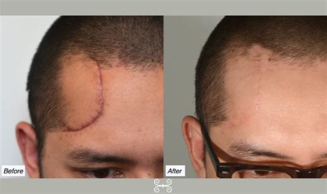Plastic Surgery Scar Face