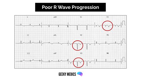 Poor R Wave Progression
