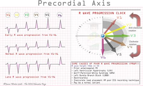 R Wave Progression