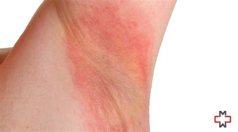 Rash Under Armpit