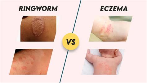 Ringworm Vs Eczema