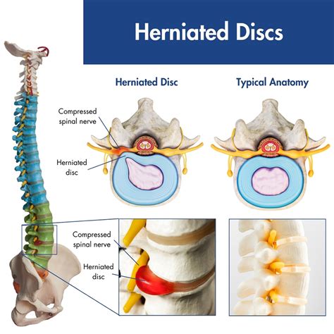 Ruptured Disk Neck