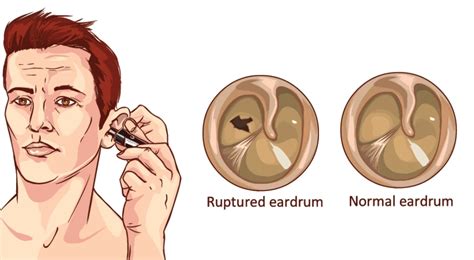Ruptured Eardrum Healing Time