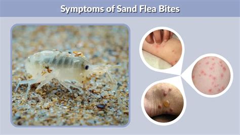 Sand Flea Bite