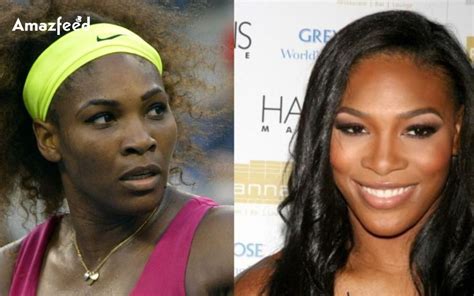 Serena Williams Surgery Face