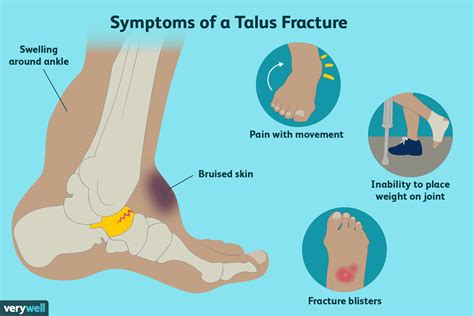 Shattered Talus Bone