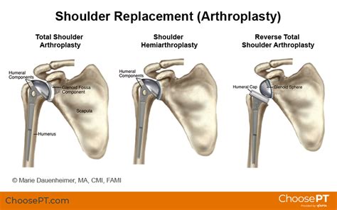 Shoulder Replacement Surgery