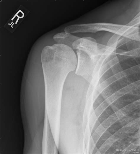 Shoulder X Ray