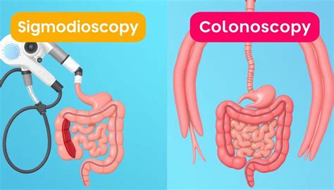 Sigmoidoscopy Vs Colonoscopy